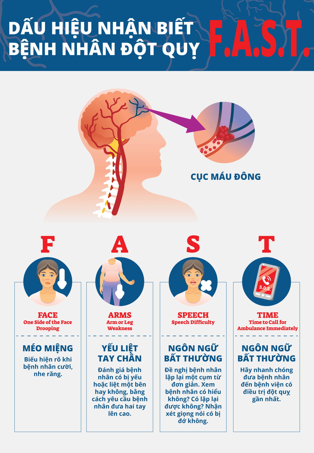 Dấu hiệu đột quỵ